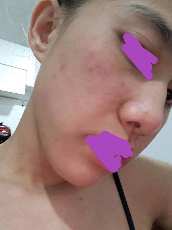 Spa Shynh House bỏ rơi khách hàng, người thực hiện dịch vụ lăn kim không phải là bác sỹ?